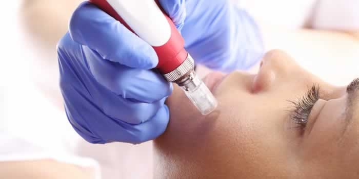 micro needling